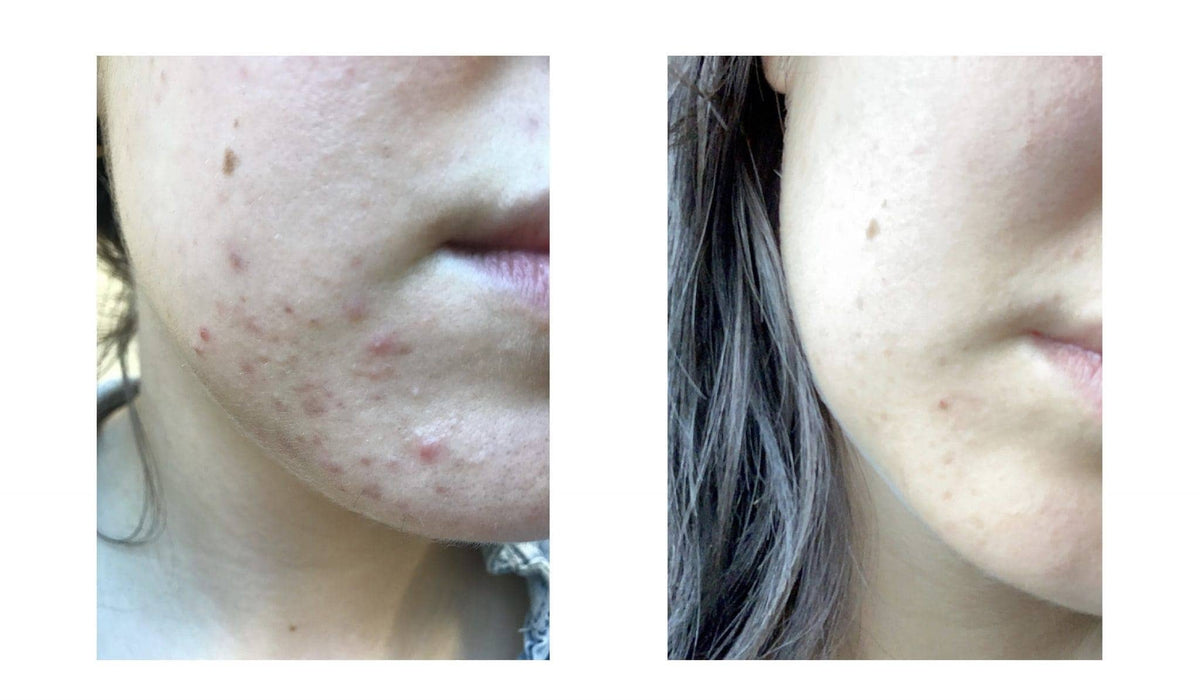 Så blir du av med hormonell acne