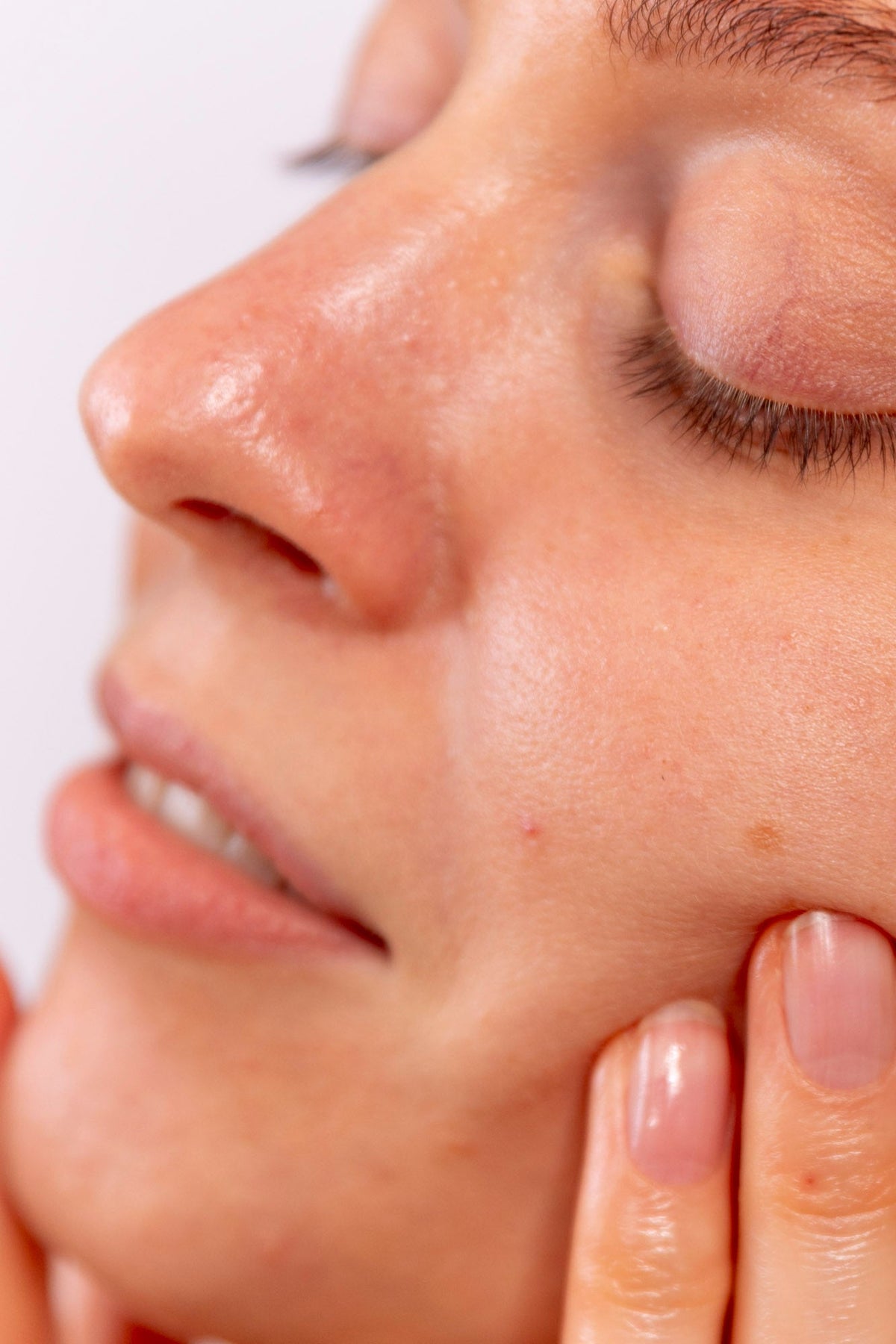 Så blir du av med perioral dermatit