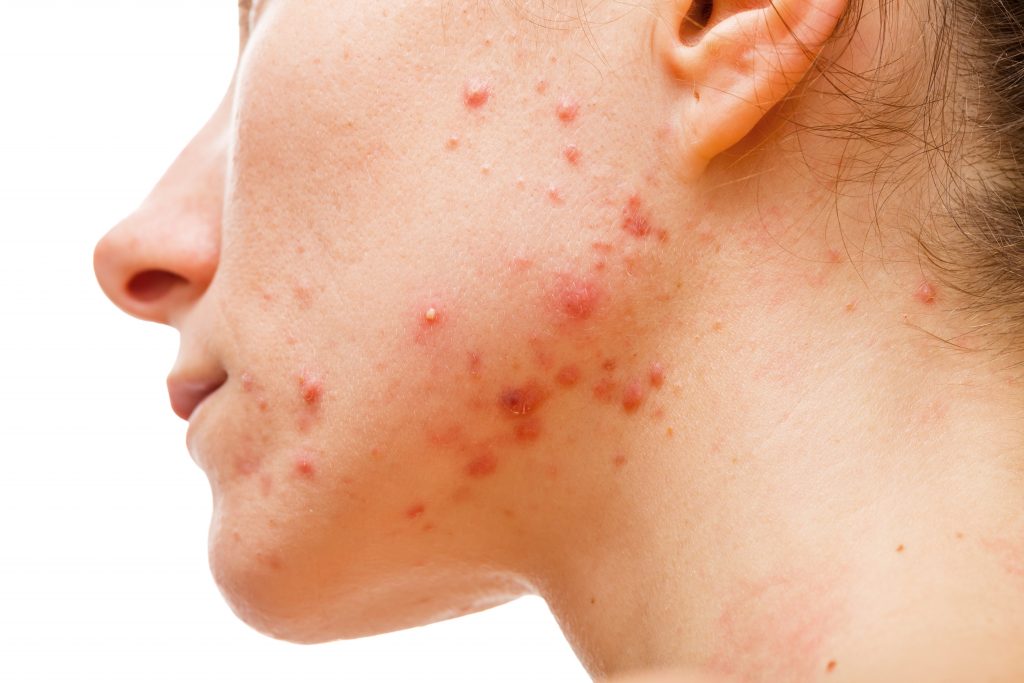 varför får man acne